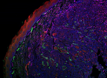 Cancer cell interactions in metastasis